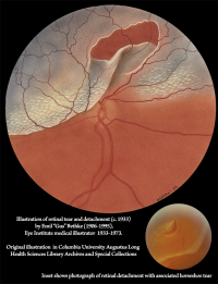 Illustration of Retinal tear and Detachment